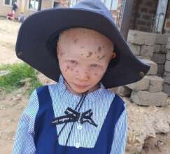 A young girl with her new hat after her skin check