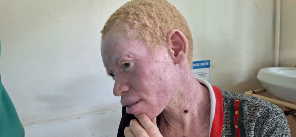 A young man in Butaleja with painful, dry skin