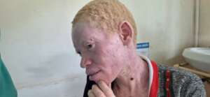 A young man in Butaleja with painful, dry skin