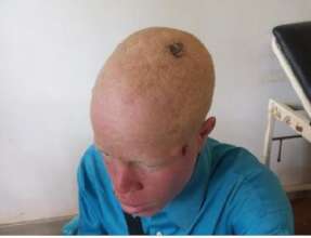 Teenager Brian before his surgery