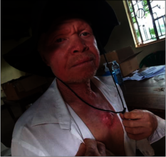 Fred, father of four, received skin cancer surgery