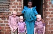 End skin cancer for people with albinism in Uganda