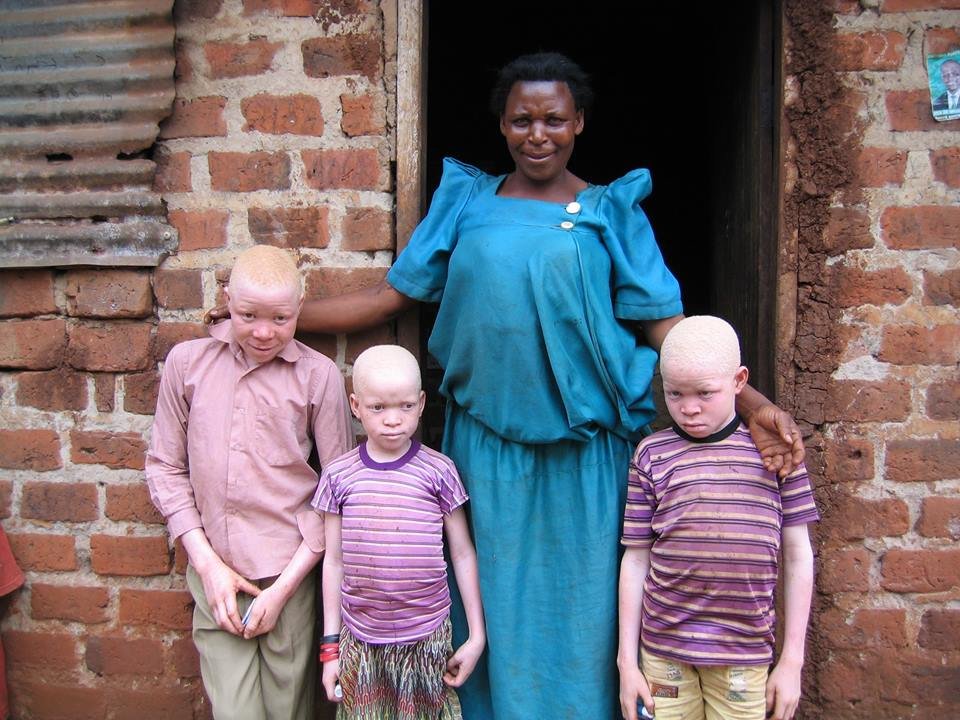 End skin cancer for people with albinism in Uganda