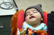 Restore Smiles of Cleft Patients