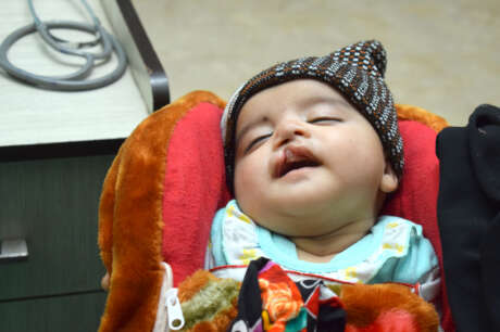 Restore Smiles of Cleft Patients
