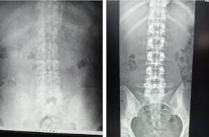 X-ray: incorrect vs correct level of radiation