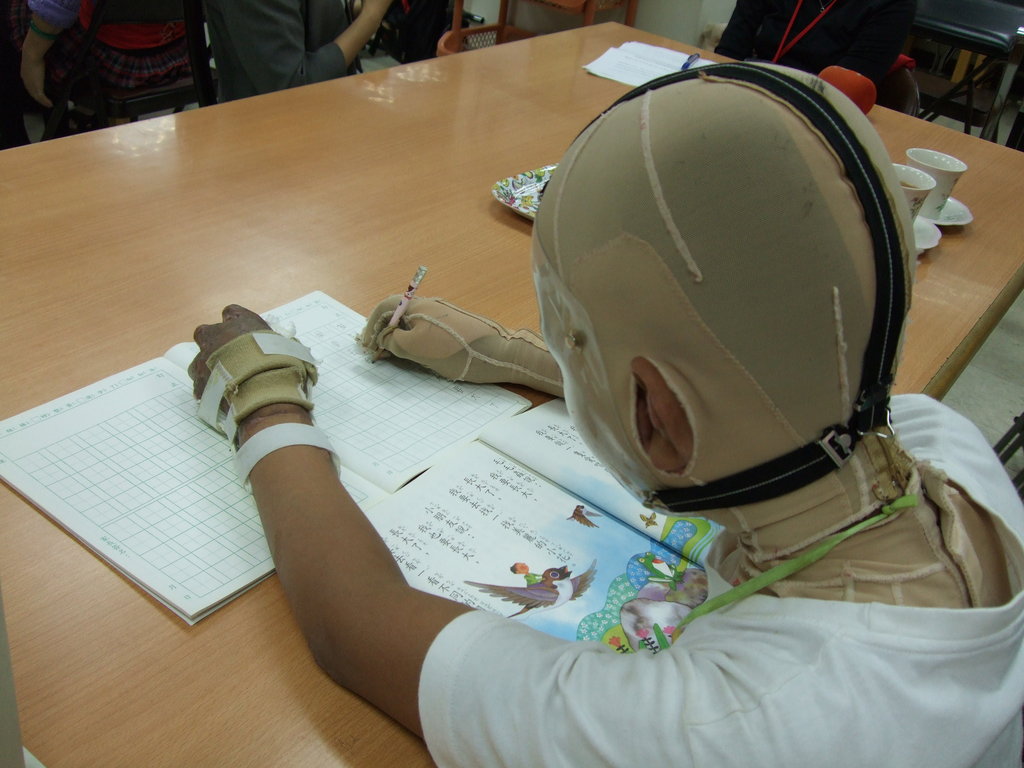 Rehabilitation for burn survivors in Taiwan