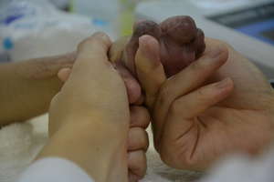 Healing the hands of a child