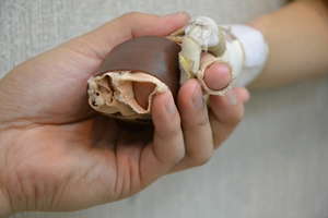 Splints help fight scar contracture