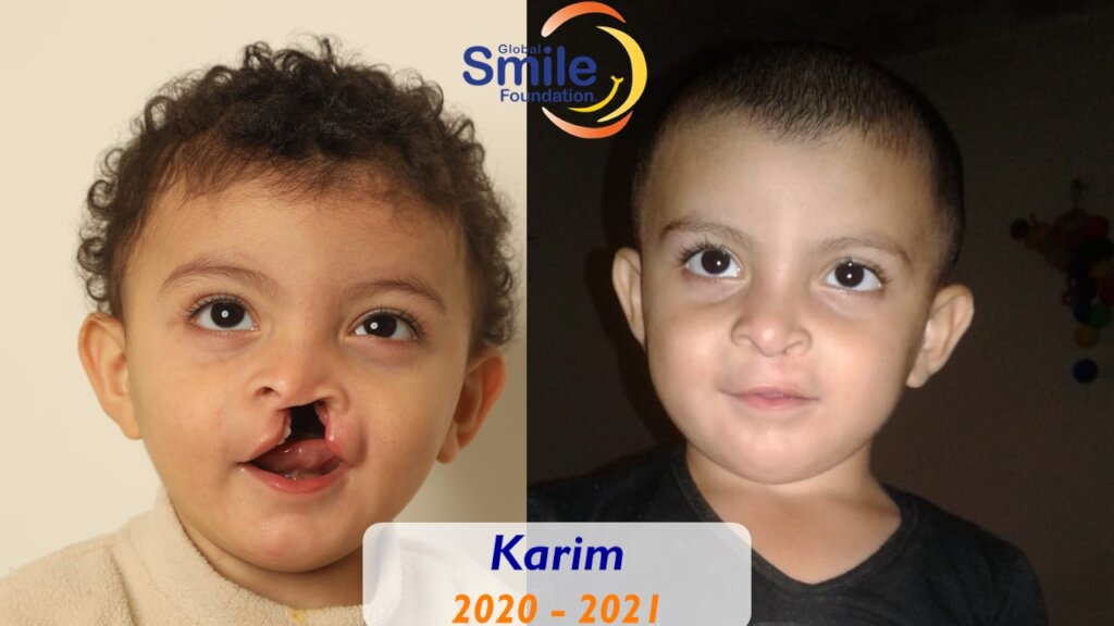 Help 10 Children Born with Cleft in Lebanon/MENA