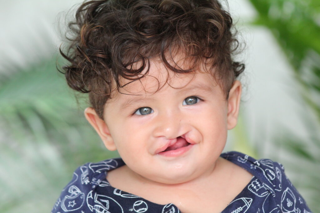 Saving Lives for Children born with Cleft