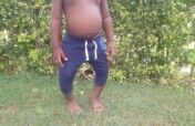 Help correct baby Eli's bowed legs in Uganda