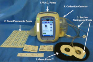 Vacuum Assisted Closure System