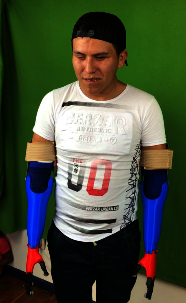 3D printed prosthetic arms and hands