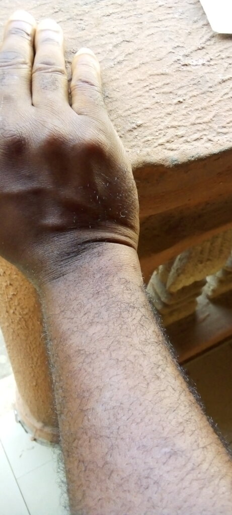 Support Darlington's Medical Treatment in Nigeria