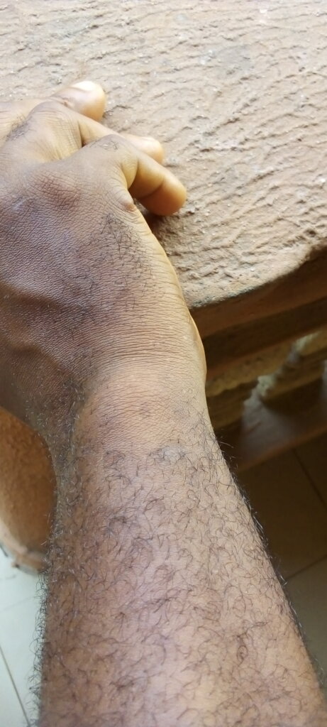 Support Darlington's Medical Treatment in Nigeria