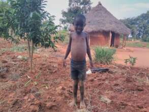 Kwashiorkor because of lack of  proper nutrition