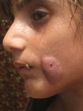 Female with skin infection