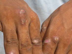 IDPs drinking flood water & find skin disease