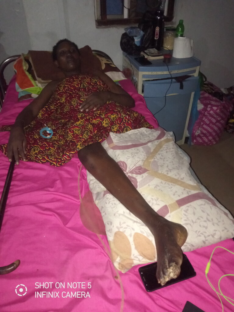 Help Mercy to Amputate her Decaying Leg in Nigeria