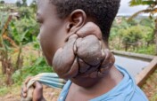 Fund Surgery and Education for 3 Orphans in Kumbo.