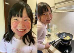 After laser treatment, red spots are visible