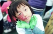 Support children with facial differences in Taiwan