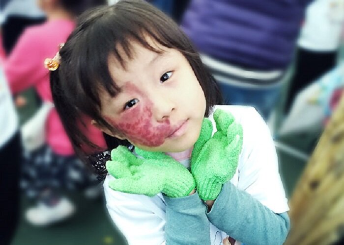 Support children with facial differences in Taiwan