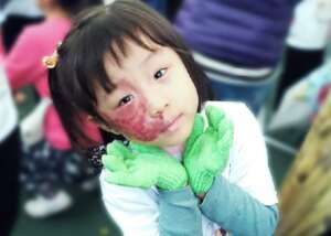 Support children with facial differences in Taiwan