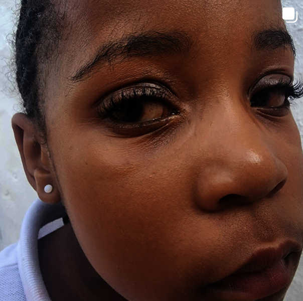 Restoring Eyesight to Children in Africa