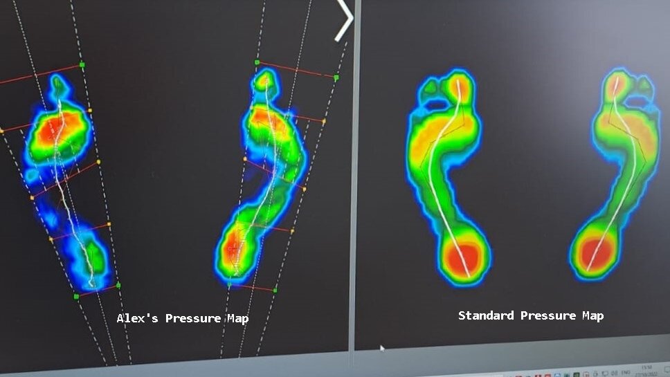 Change the Future for A Child with Scoliosis