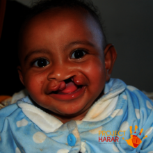 Asli before treatment