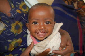 Selam before cleft surgery at GAMBY hospital.