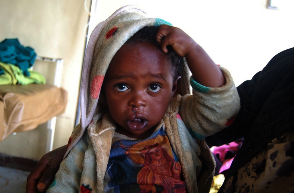 Fedhasa after cleft surgery.