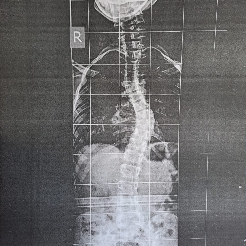 Fighting Childhood Scoliosis With Monkey Bars