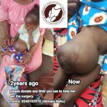 OMPHALOCELE
