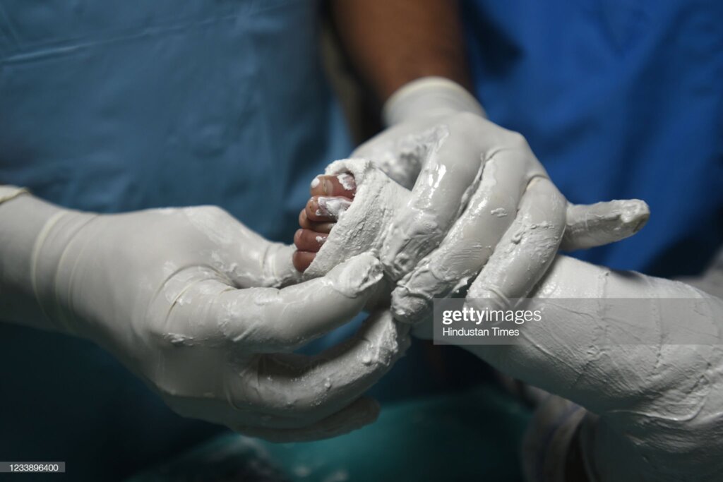 Club foot project for the marginalized children