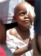 Young Amadeus- one of the first patients