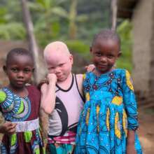 Raise awareness for the powerless. Albino equality