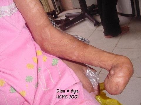 Adjustable prosthetic arms for children and adults