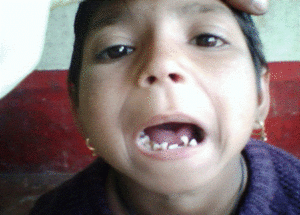 A cerebral Palsy child