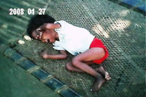 Cerebral Palsy child