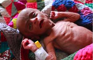 Malnourished Infant