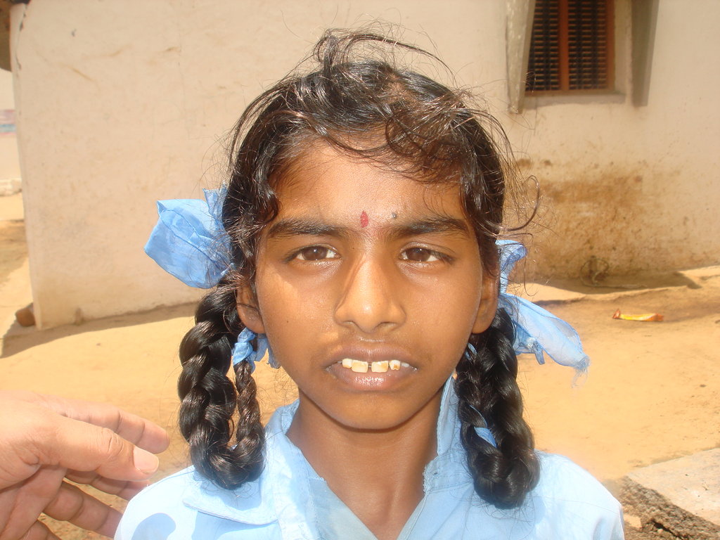 Protect children from fluorosis in Pavagada, India