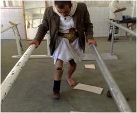 Learning to walk with prosthetic legs