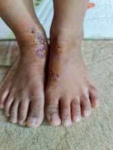 More infections