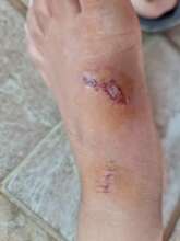 Skin infections