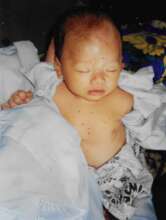 Little Baby Lai with Dengue Fever From Mosquitoes