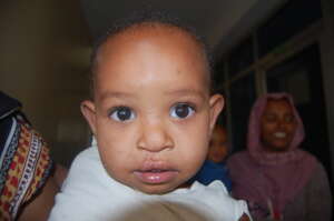 Mahir after receiving surgery on his cleft palate.