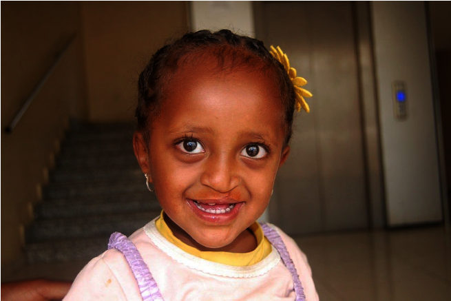 Sitralla, 1 year after cleft palate surgery